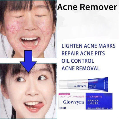 Japanese Acne Care Cream – Gentle Spot Treatment for Clearer Looking Skin